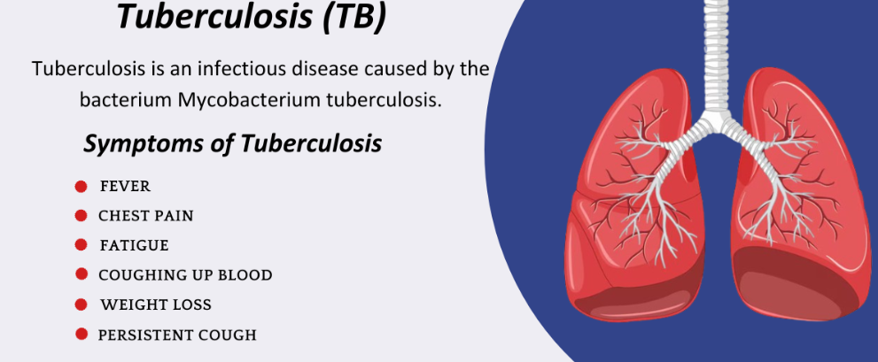 24 March 2025: Pib Summary For Upsc | Updated June 17, 2025 24 March 2025: Pib Summary For Upsc- Tuberculosis
